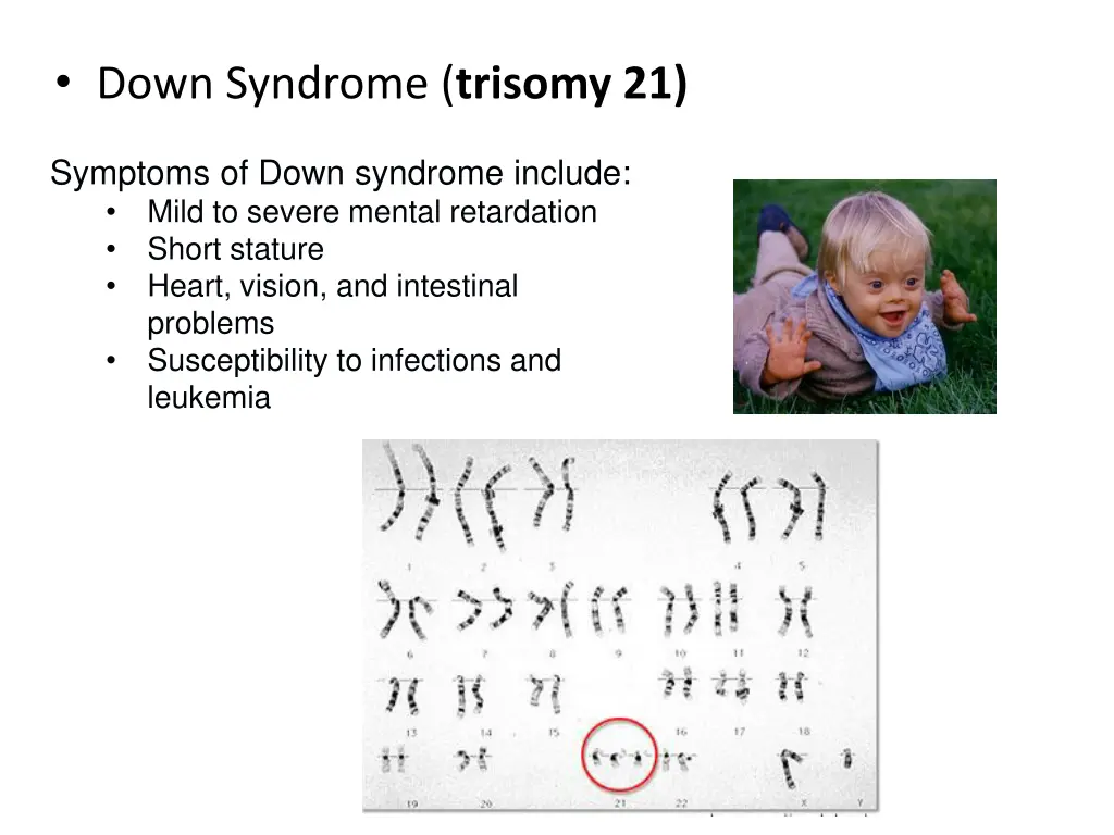 down syndrome trisomy 21