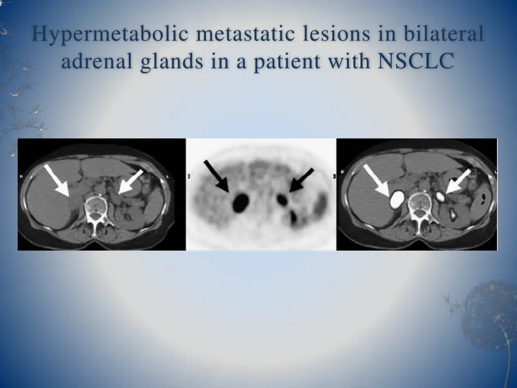 hypermetabolic metastatic lesions in bilateral