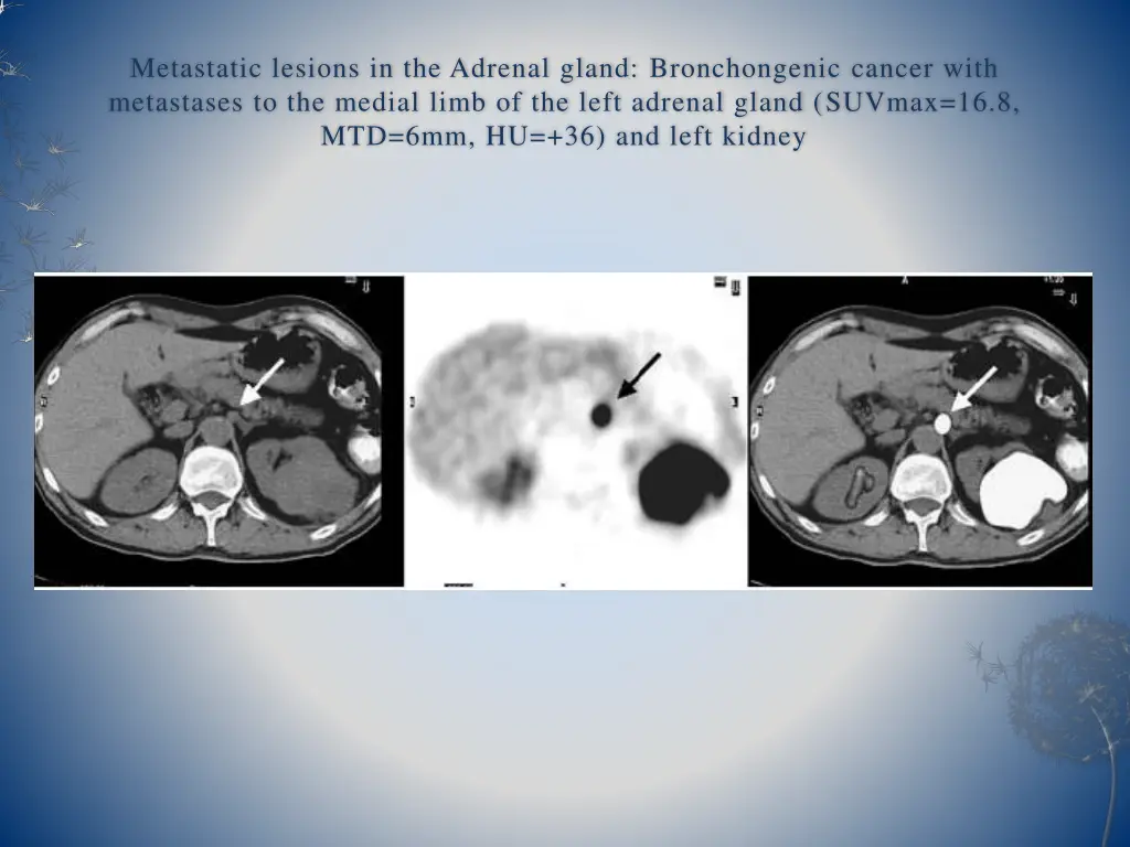 metastatic lesions in the adrenal gland