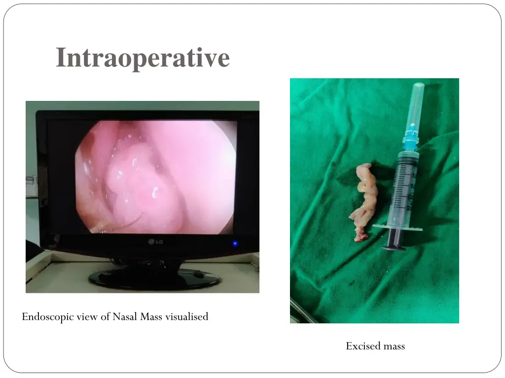 intraoperative