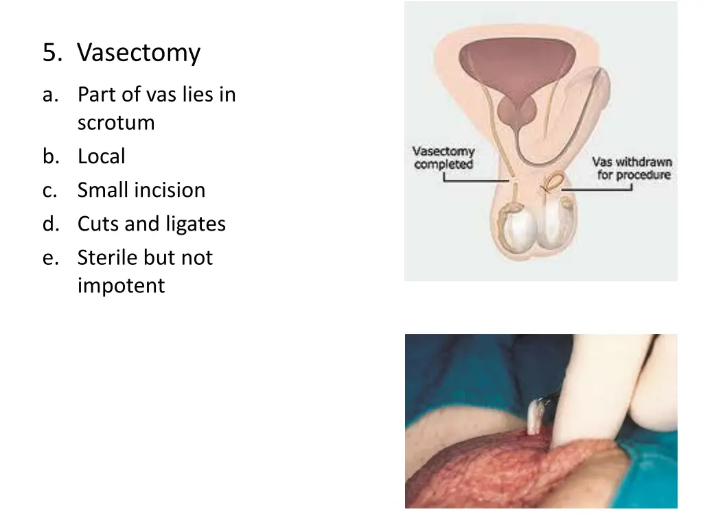 5 vasectomy