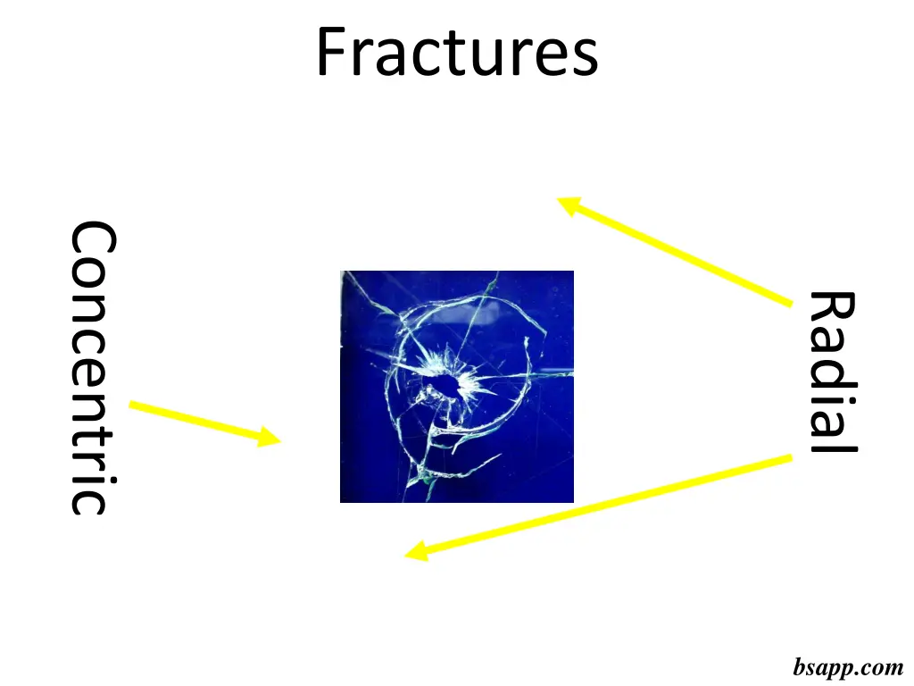 fractures