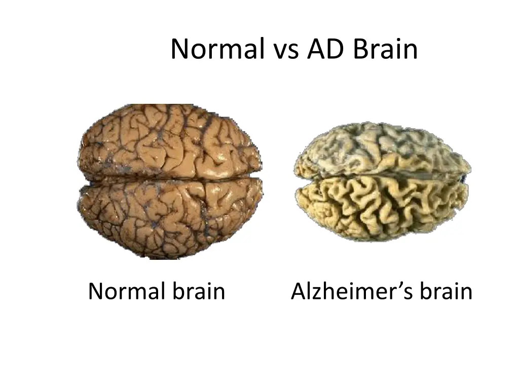 normal vs ad brain