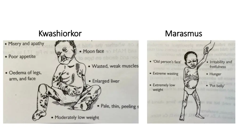 kwashiorkor kwashiorkor