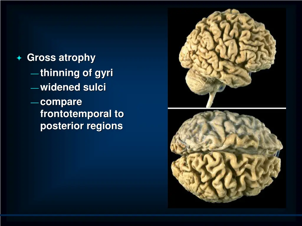 gross atrophy thinning of gyri widened sulci