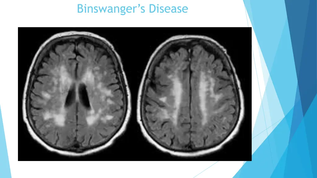 binswanger s disease 1