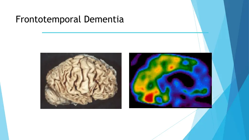 frontotemporal dementia