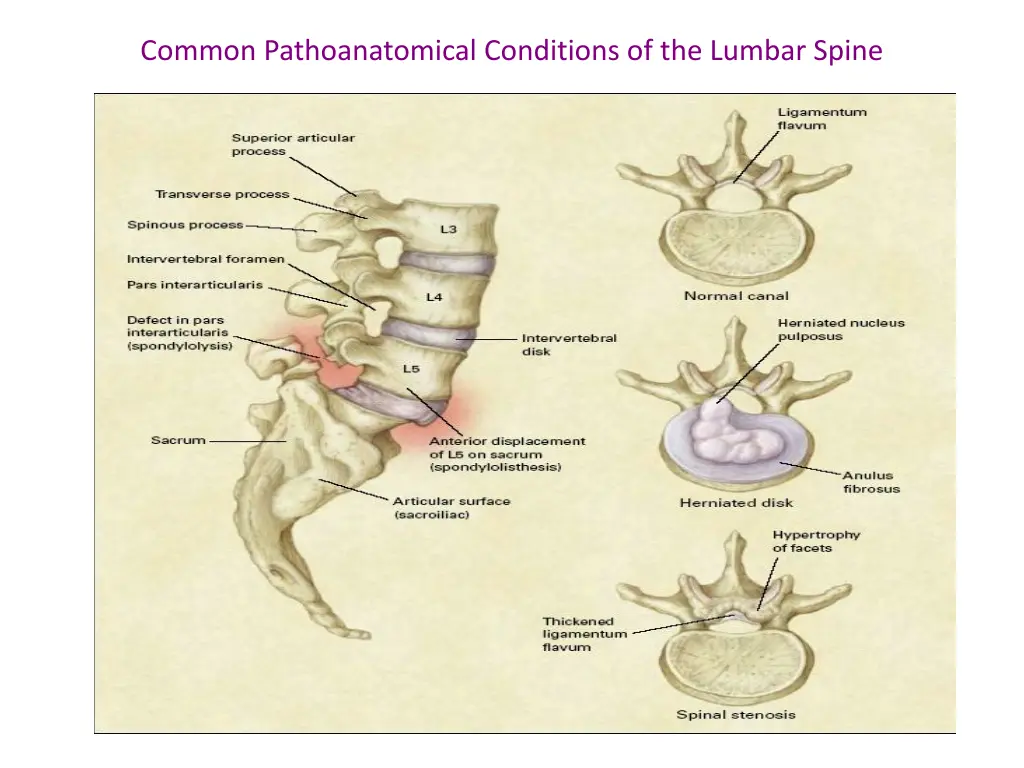 common pathoanatomical conditions of the lumbar