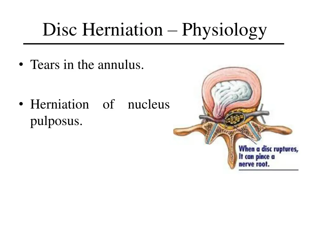 disc herniation physiology