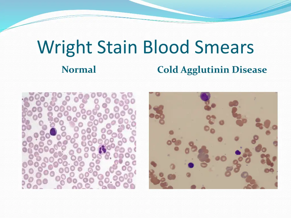 wright stain blood smears 1