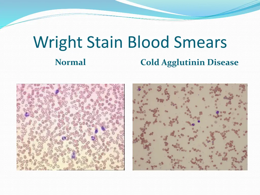 wright stain blood smears