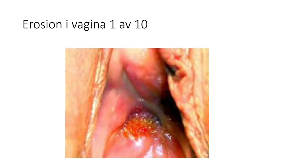 erosion i vagina 1 av 10