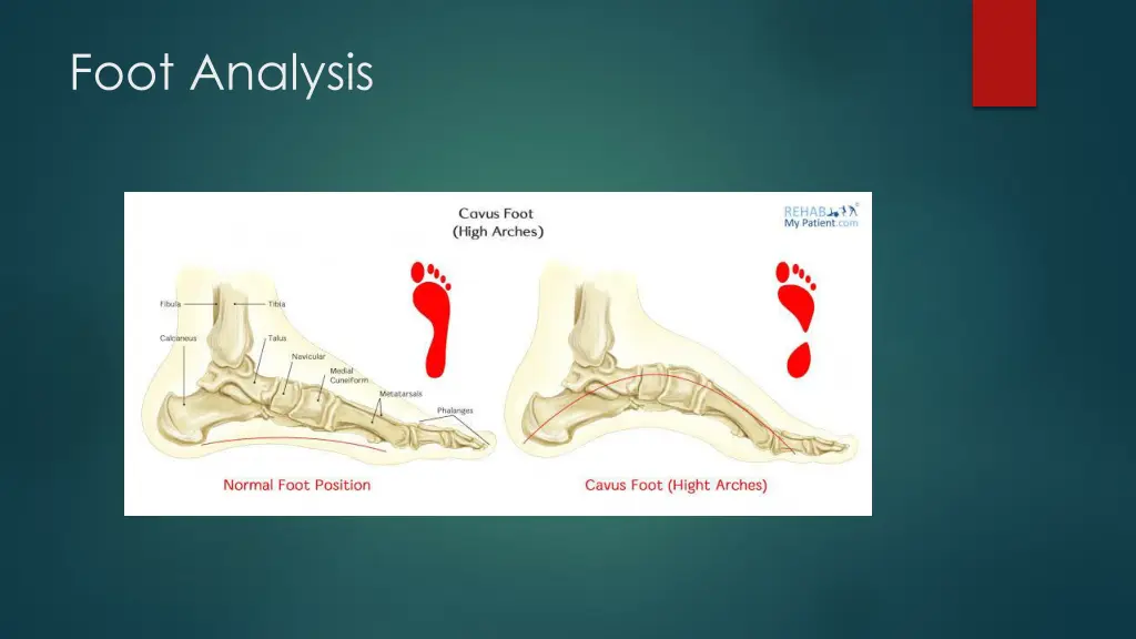 foot analysis