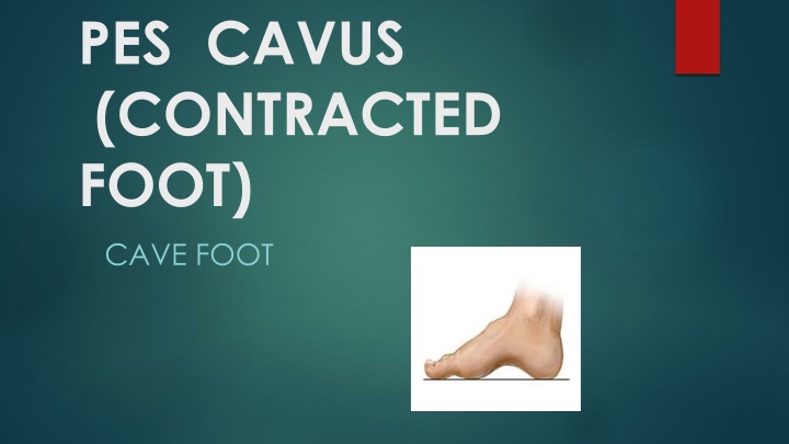 pes cavus contracted foot