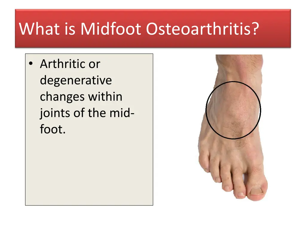 what is midfoot osteoarthritis