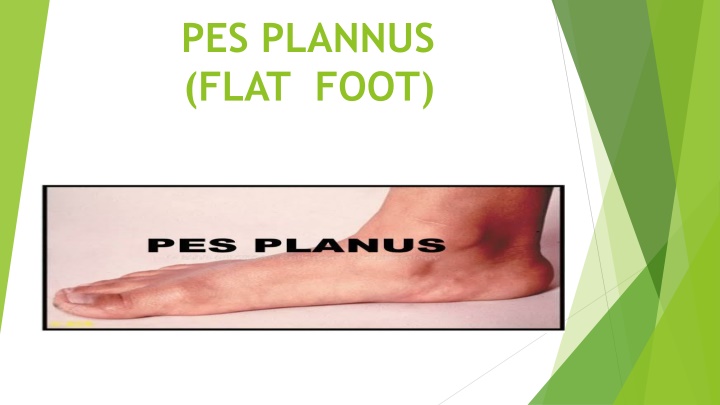 pes plannus flat foot