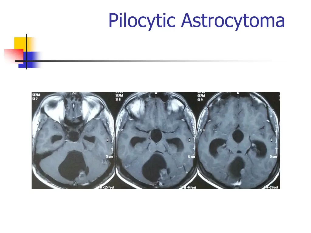 pilocytic astrocytoma 1