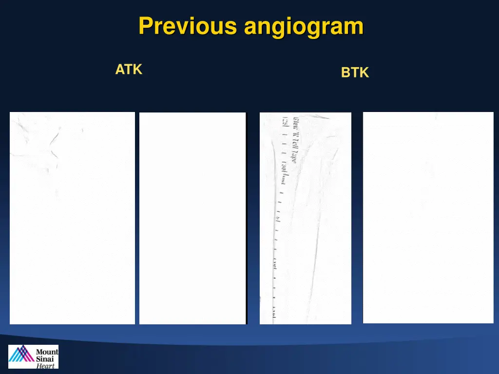 previous angiogram