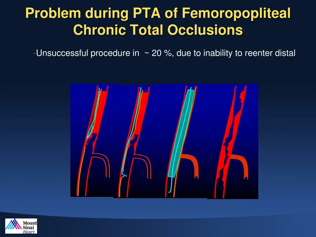 problem during pta of femoropopliteal chronic