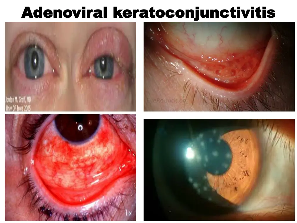 adenoviral adenoviral keratoconjunctivitis 1