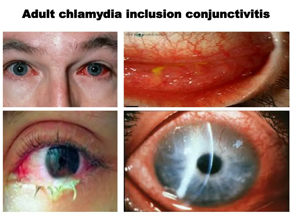 adult chlamydia inclusion conjunctivitis adult