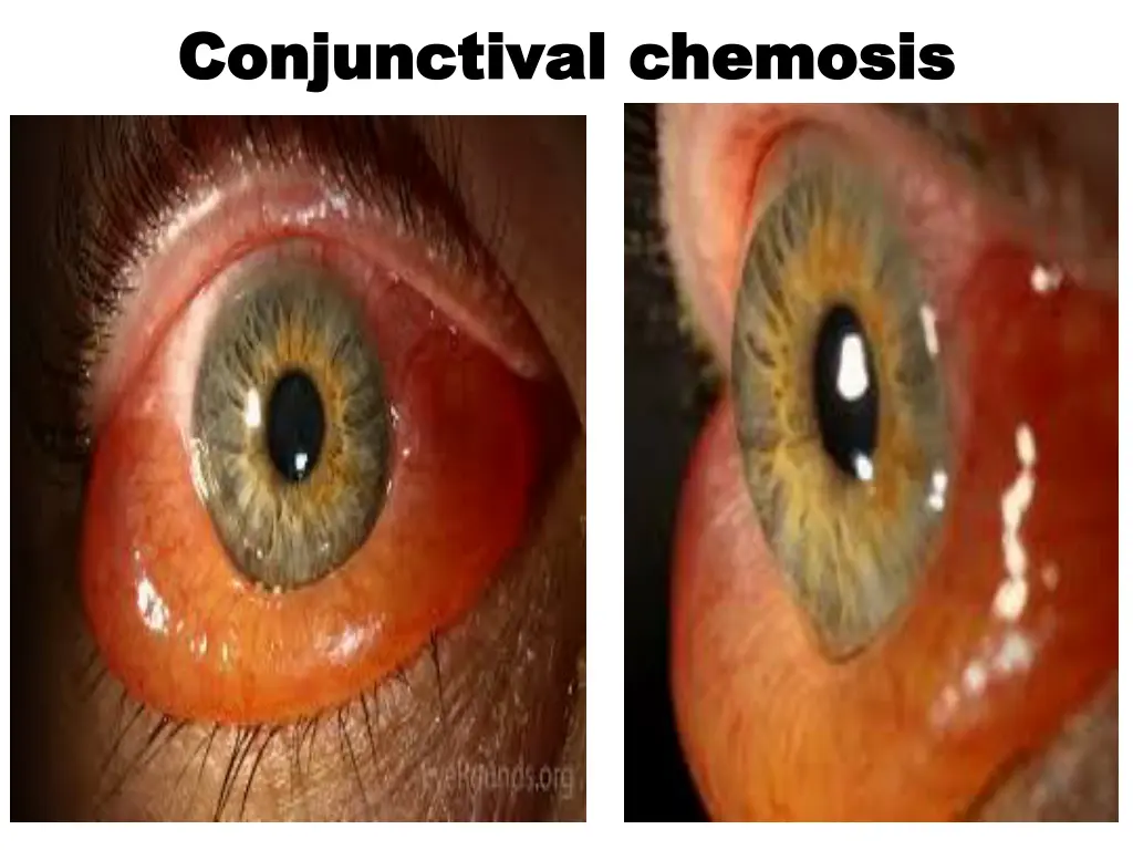 conjunctival conjunctival chemosis