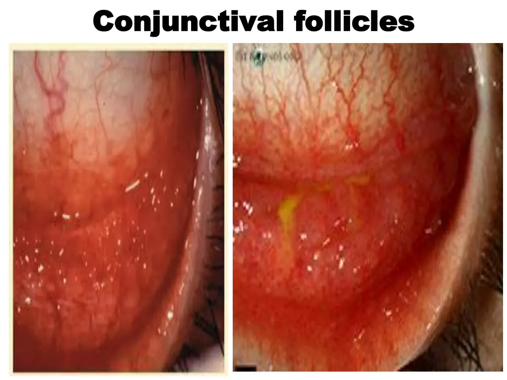 conjunctival conjunctival follicles