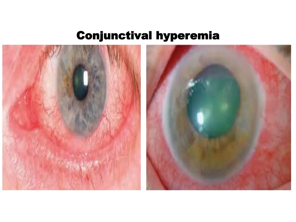 conjunctival conjunctival hyperemia