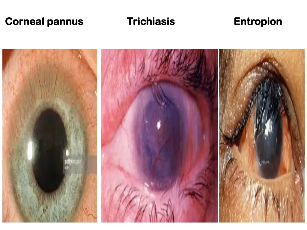 corneal corneal pannus