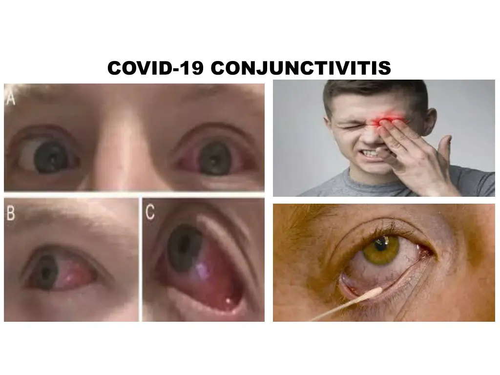 covid 19 conjunctivitis