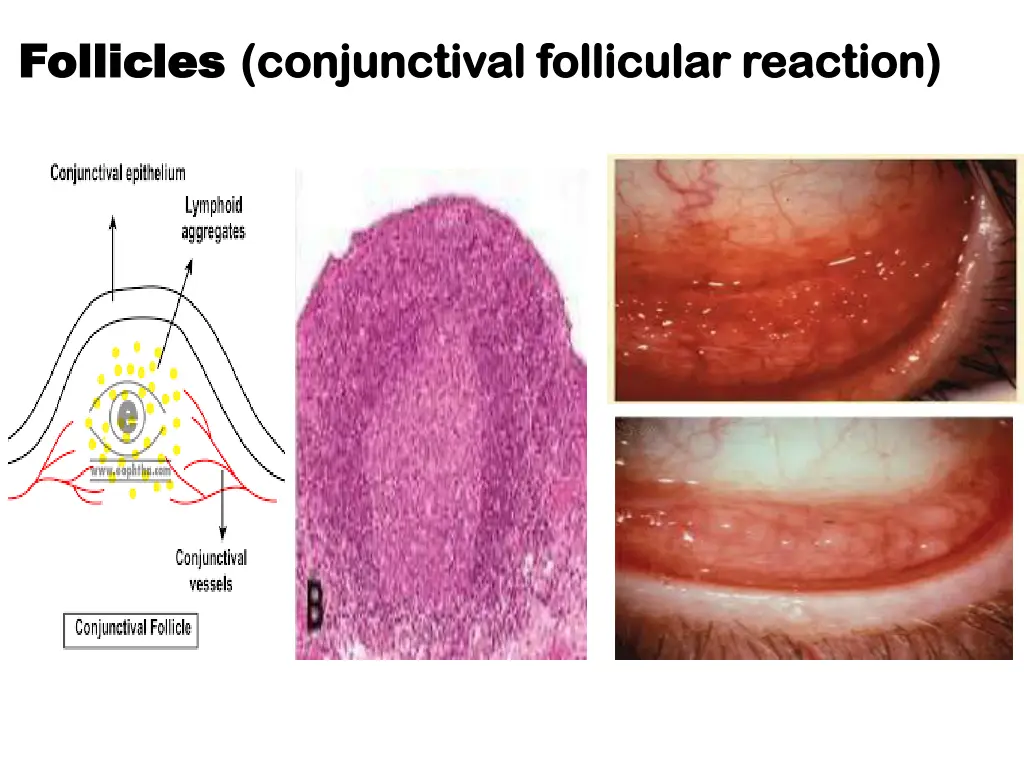 follicles follicles conjunctival conjunctival