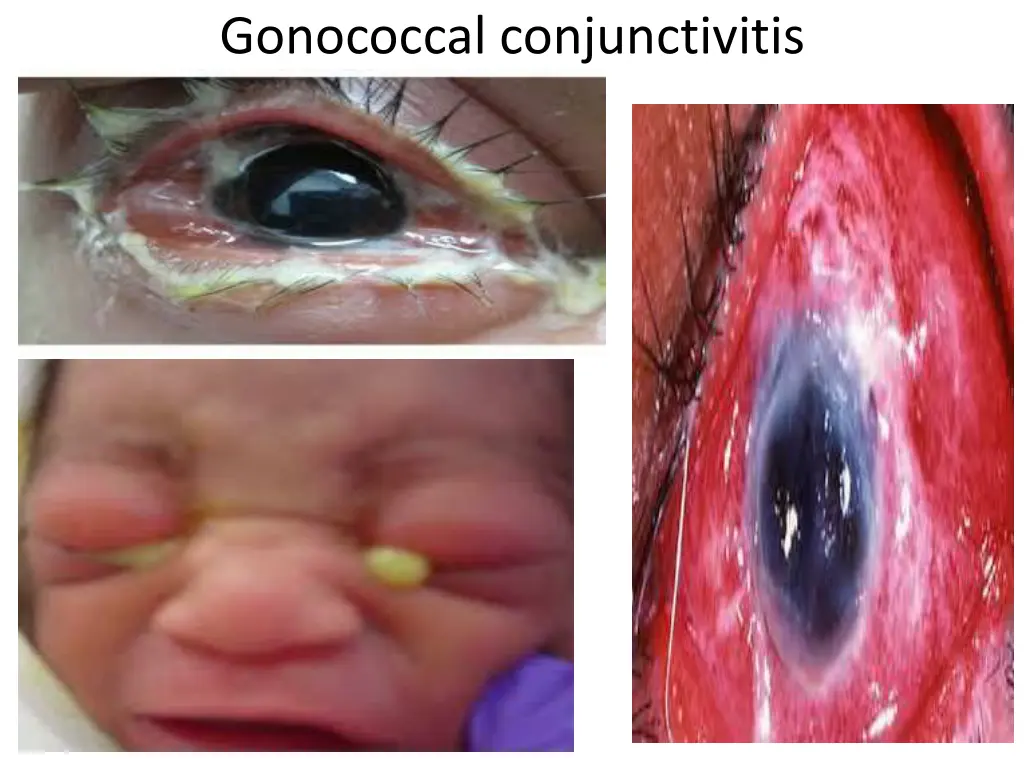 gonococcal conjunctivitis 1