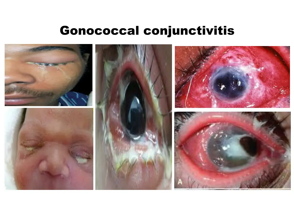 gonococcal conjunctivitis