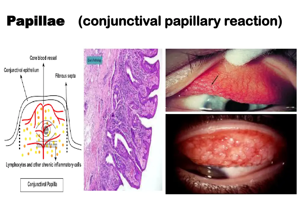 papillae papillae conjunctival conjunctival