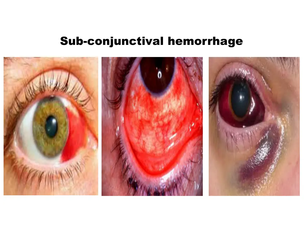 sub conjunctival hemorrhage