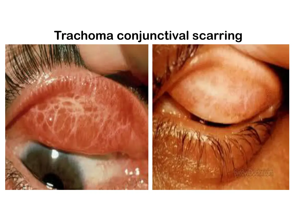 trachoma conjunctival scarring