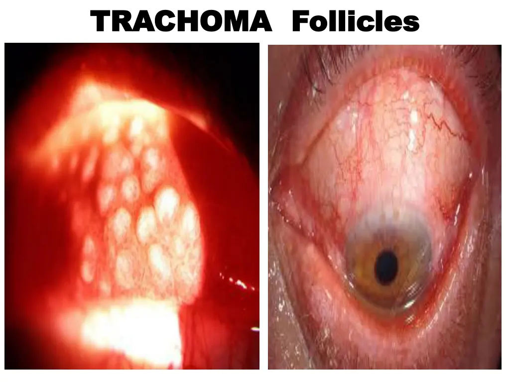 trachoma follicles trachoma follicles