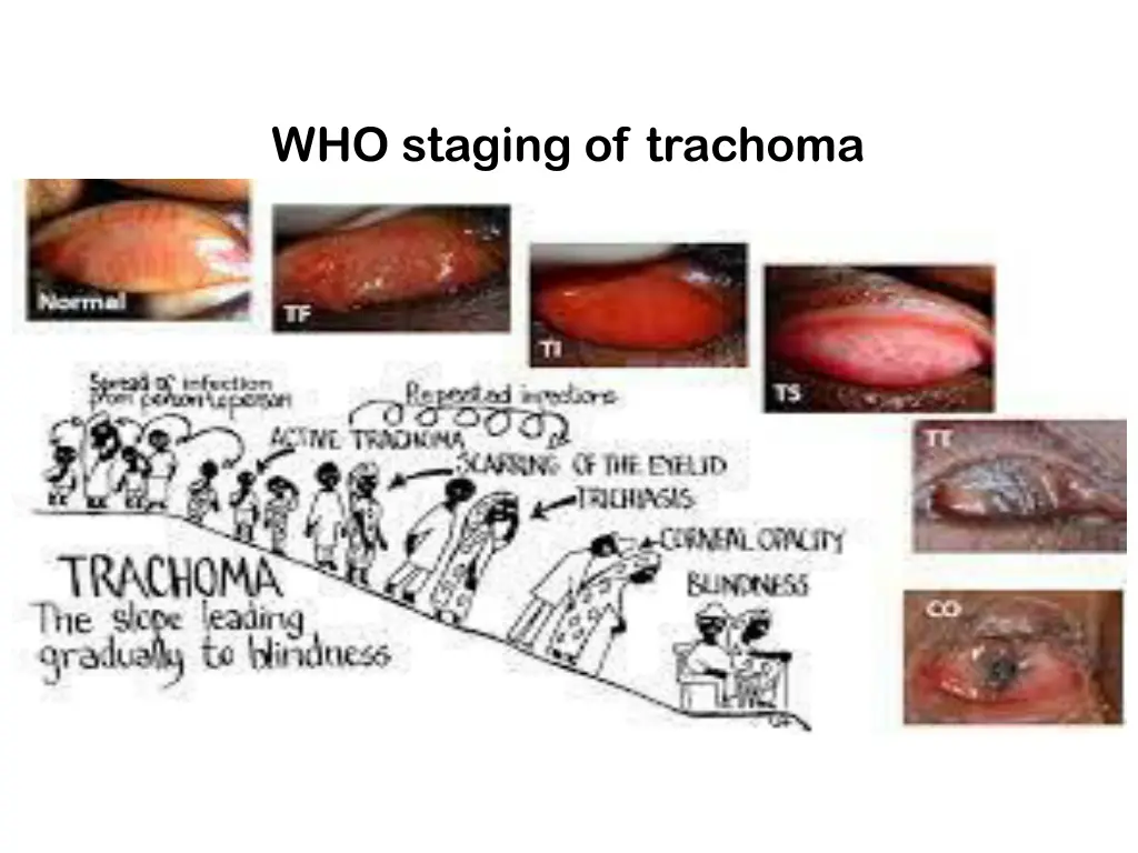 who staging of trachoma