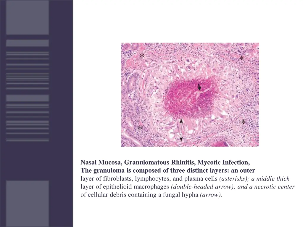 nasal mucosa granulomatous rhinitis mycotic