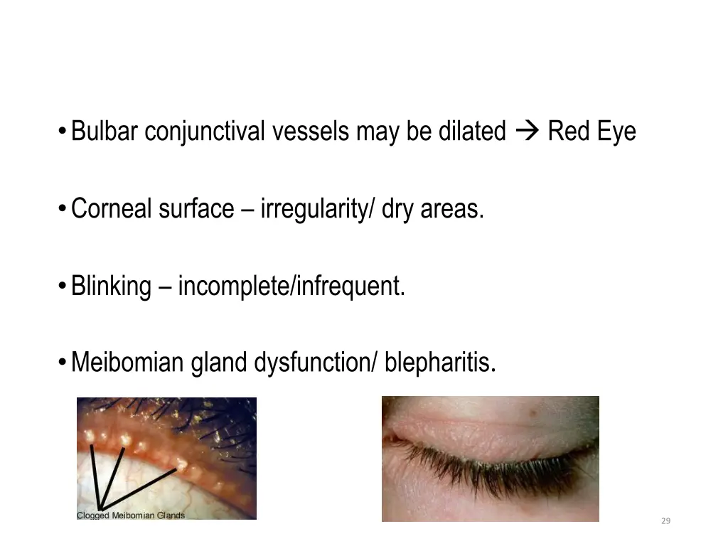 bulbar conjunctival vessels may be dilated red eye