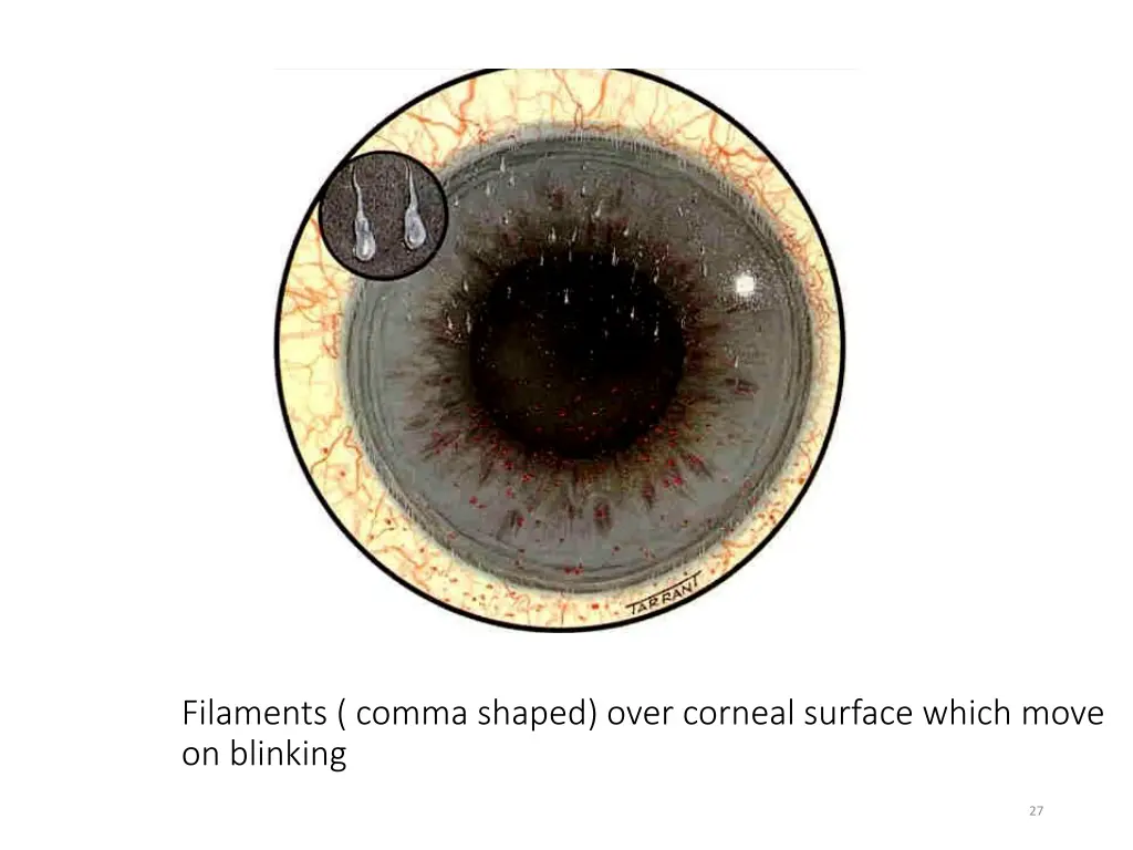 filaments comma shaped over corneal surface which