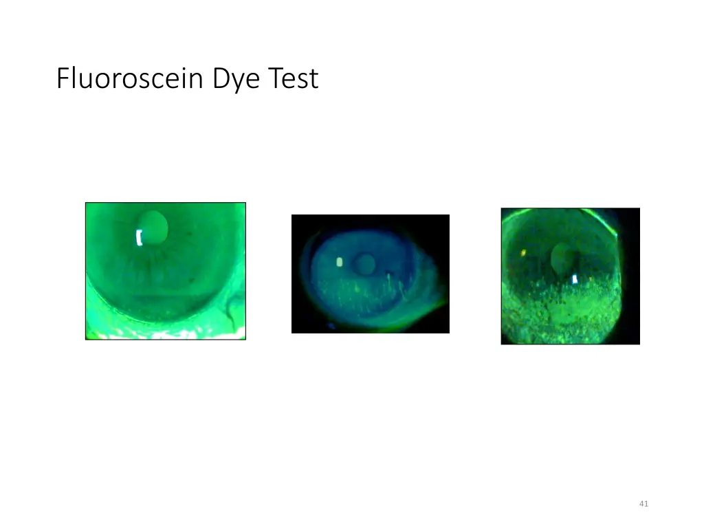 fluoroscein dye test