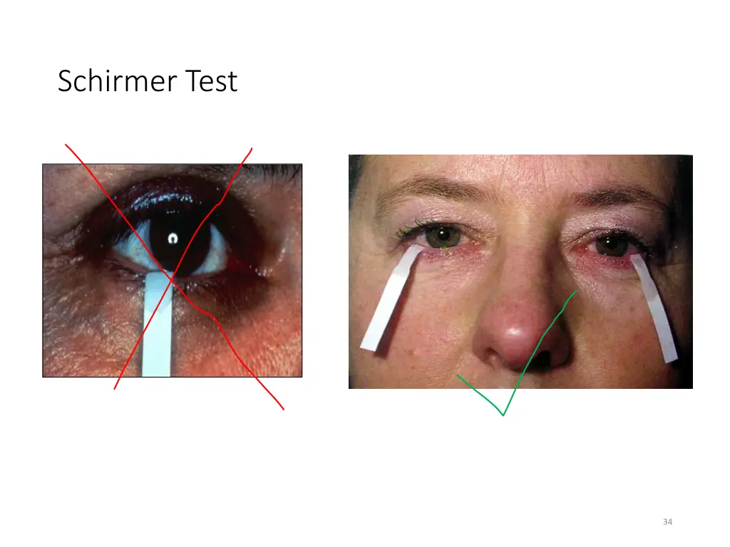 schirmer test