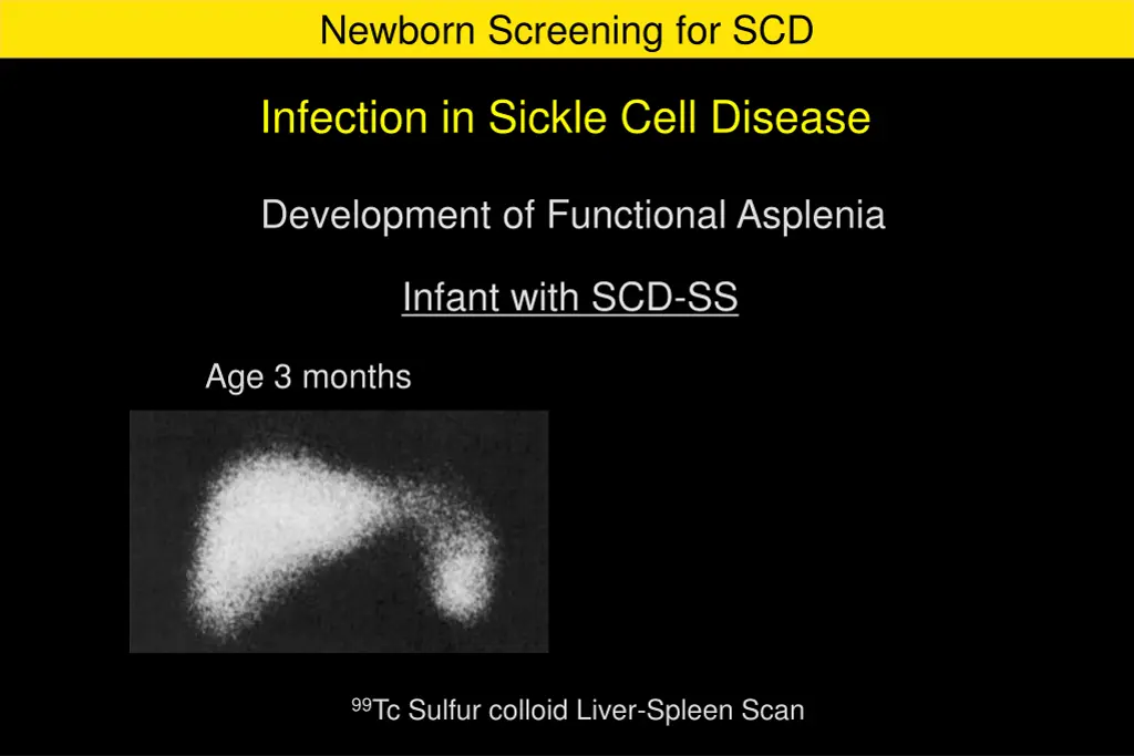 newborn screening for scd 5