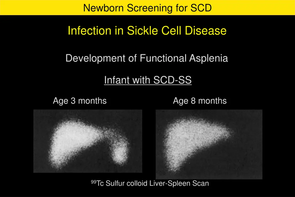 newborn screening for scd 6