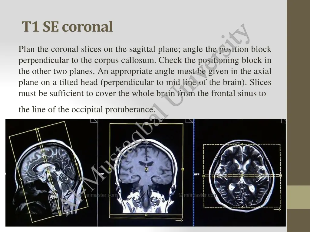 t1secoronal