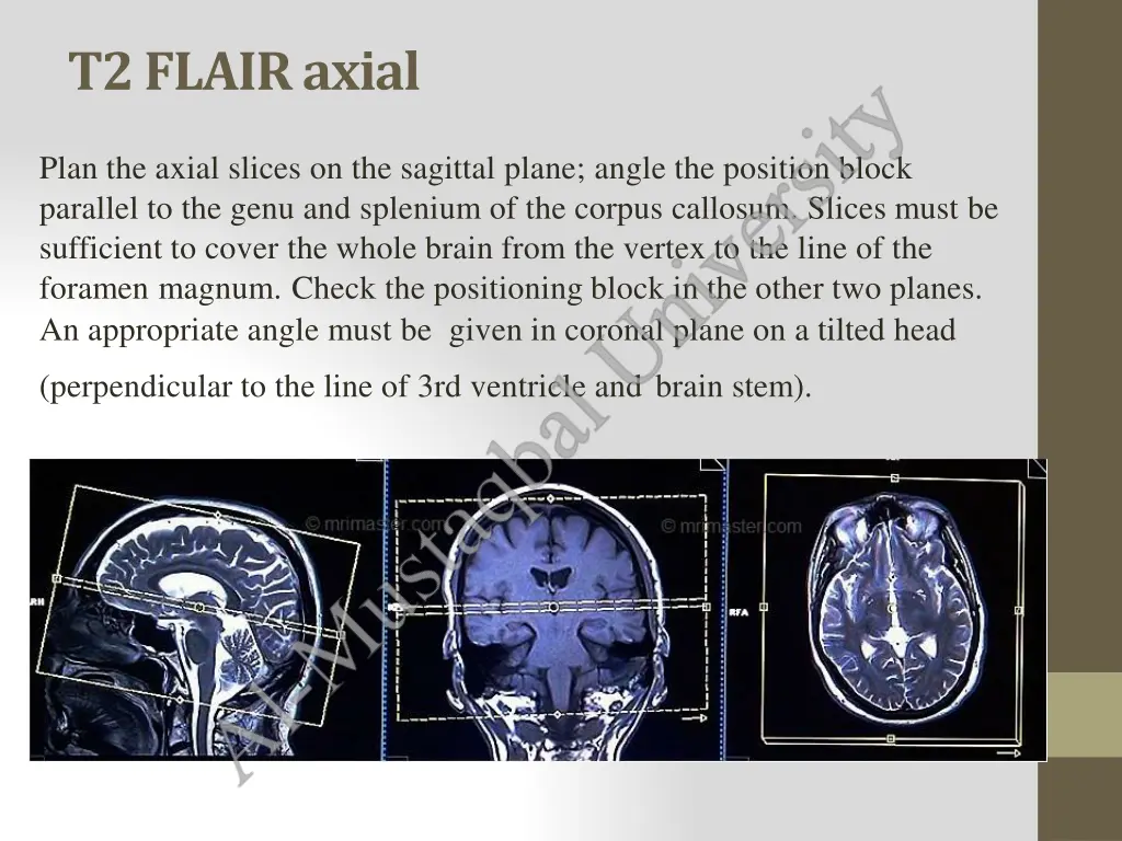 t2flairaxial