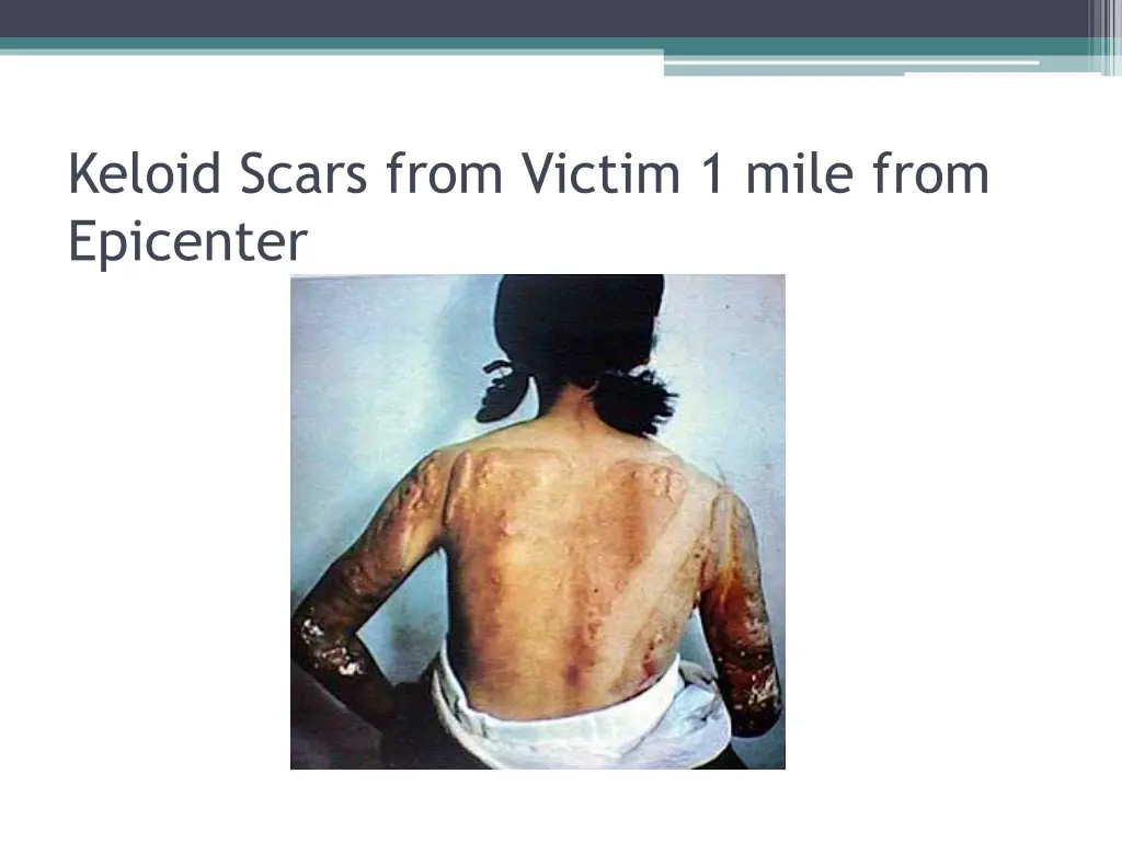 keloid scars from victim 1 mile from epicenter