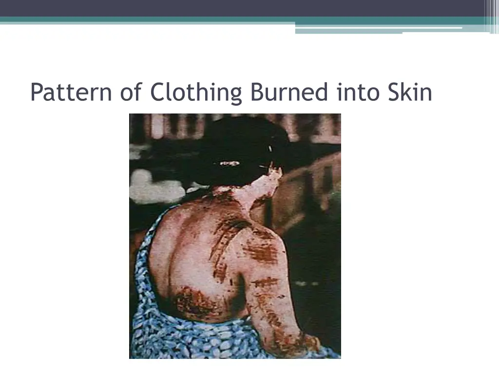 pattern of clothing burned into skin