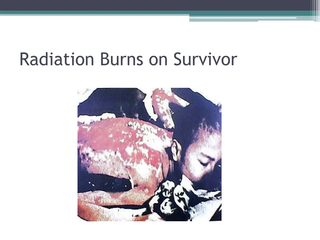 radiation burns on survivor